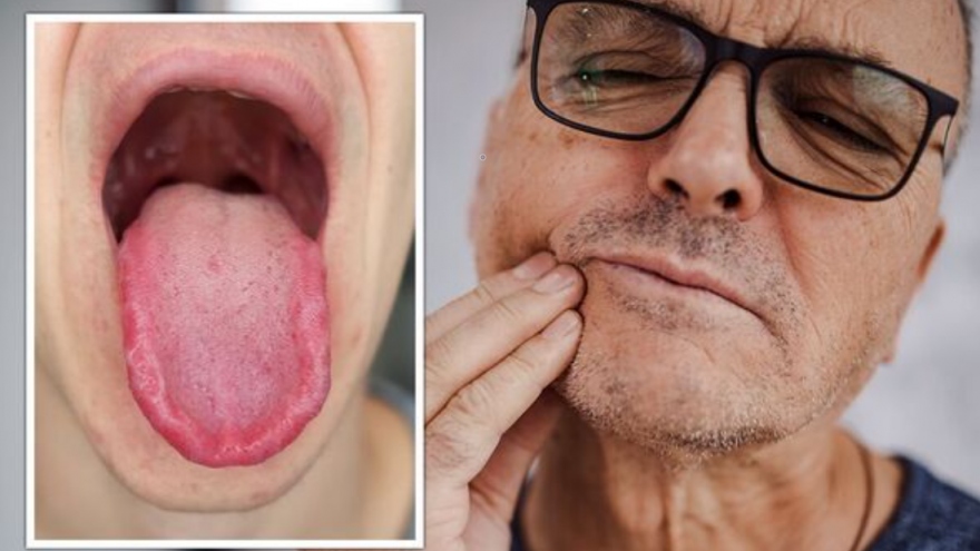 Bệnh tuyến giáp có thể gây ra hội chứng bỏng rát miệng?
